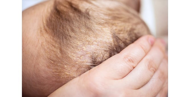 Cradle Cap: what it is, and what to do about it